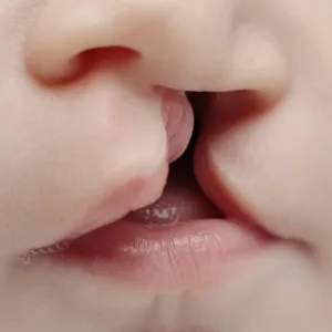 Celah Bibir dan langit-langit pada Anak