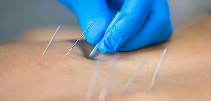 Akupunktur Untuk Kesehatan
