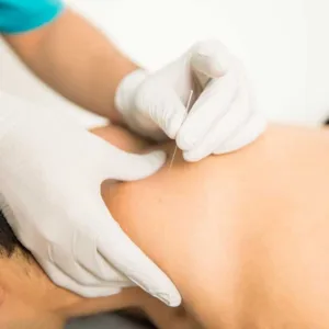 Akupunktur untuk Kesehatan, Kenali Lebih Dekat